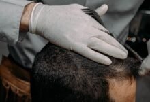 Hair Transplant
